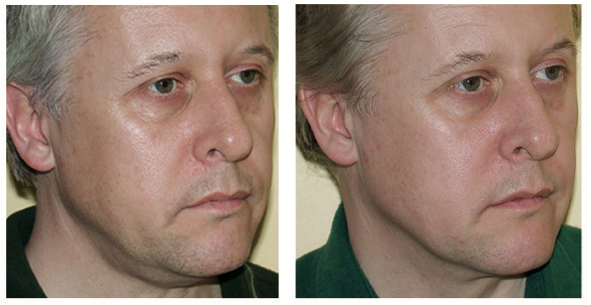 Before and After Thermage Treatment on Male Face