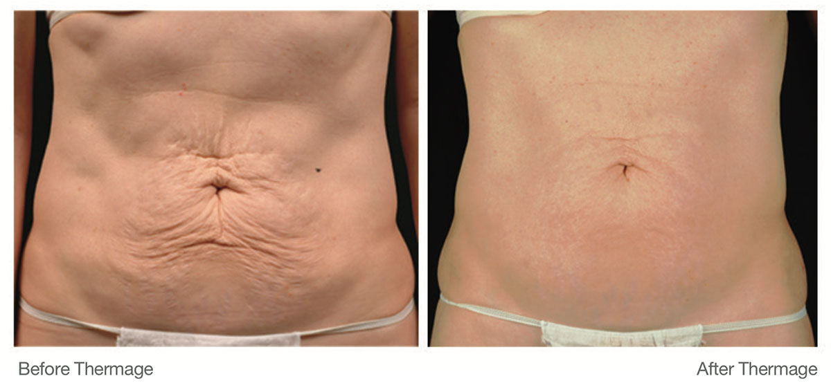 Before and After Thermage Treatment on Stomach
