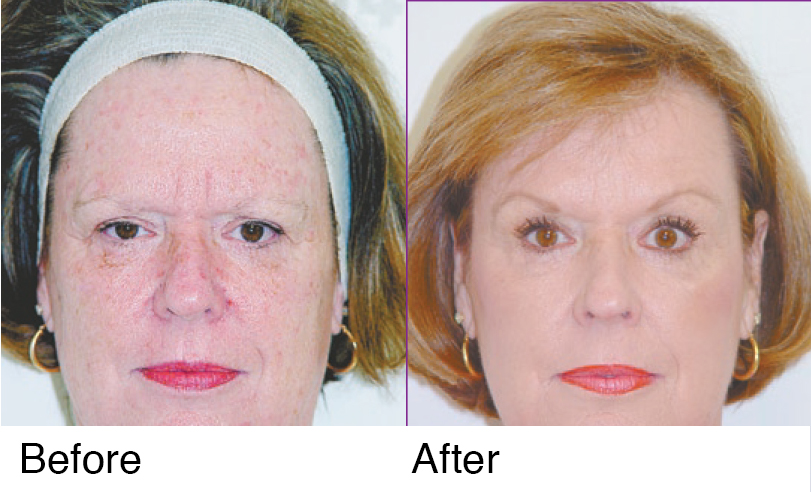 thermage anti aging kezelés